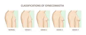 Gynecomastia Surgery Stages