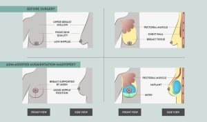 Breast Implant Revision Surgery