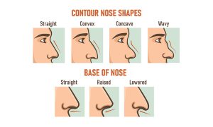 rhinoplastie