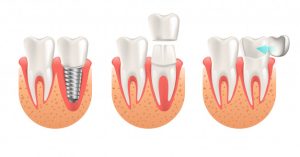 Dental Veneers