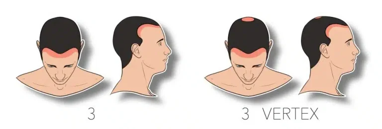3 – נשירת שיער מוקדמת