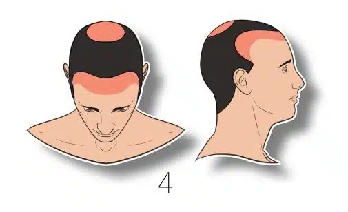 4 – נסיגה מתקדמת