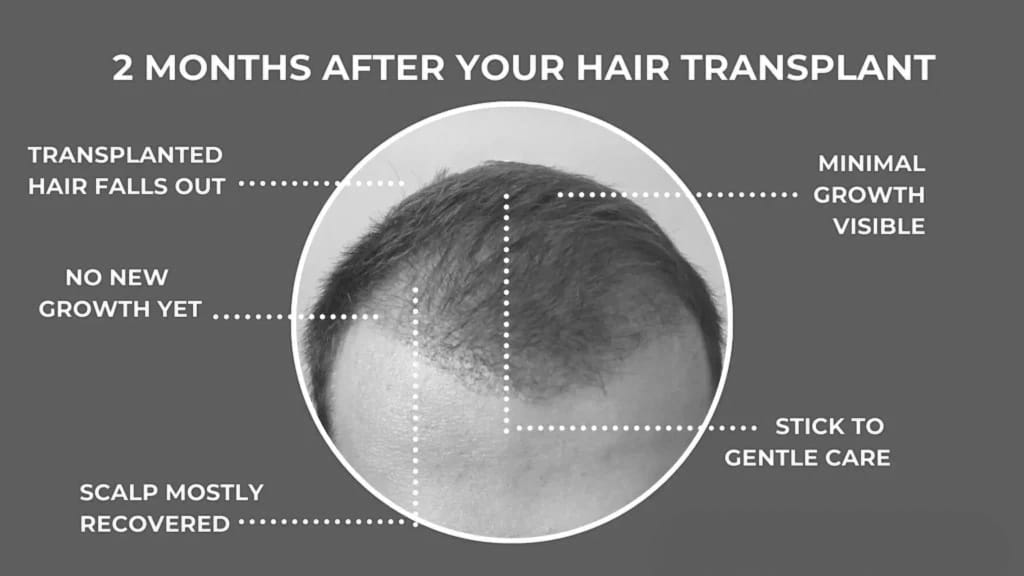 Vista dall'alto del cuoio capelluto maschile due mesi dopo il trapianto di capelli, che mostra i cambiamenti principali: i capelli trapiantati cadono, non c'è ancora una nuova crescita, il cuoio capelluto si è per lo più ripreso, è visibile una crescita minima e si raccomanda di attenersi a una cura delicata.