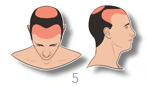 5 – נשירת שיער משמעותית