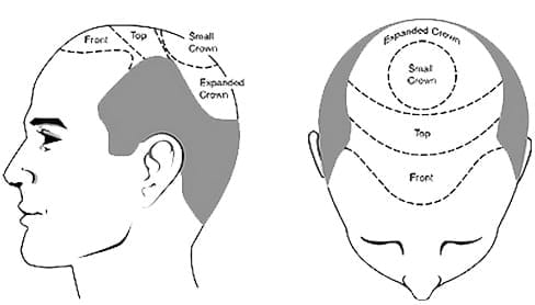 Qui est un bon candidat pour une greffe de cheveux ?  