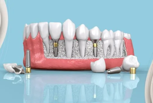 A Guide To Dental Implants In Turkey