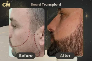 Trapianto di barba prima e dopo in Turchia