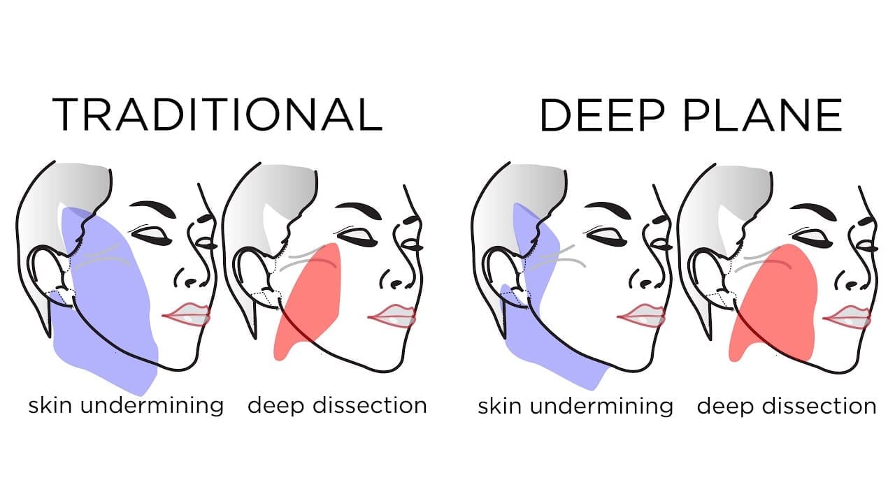 خطوات شد الوجه العميق (Deep Plane) في ClinMedica