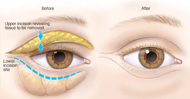تجميل الجفون (Blepharoplasty)