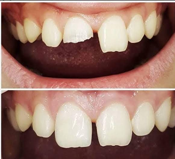 صورة مقرّبة قبل وبعد: زاوية مكسورة وفراغ في الأسنان الأمامية العلوية، ثم إعادة بنائهما بأطراف متساوية