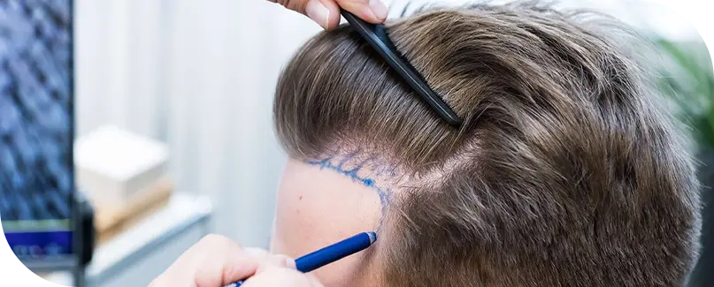 Fue Hair Transplant In Turkey