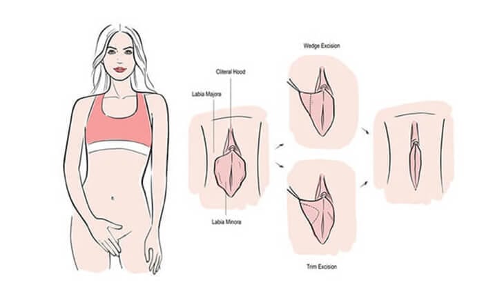 Kadınlarda genital estetik