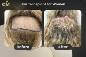 Greffe de cheveux pour femmes avant et après en Turquie