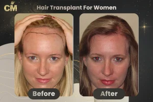 Trapianto di capelli per donne prima e dopo in Turchia