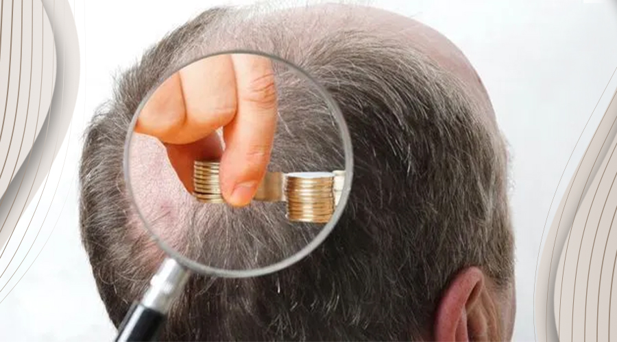 hair transplant cost in turkey clinmedica