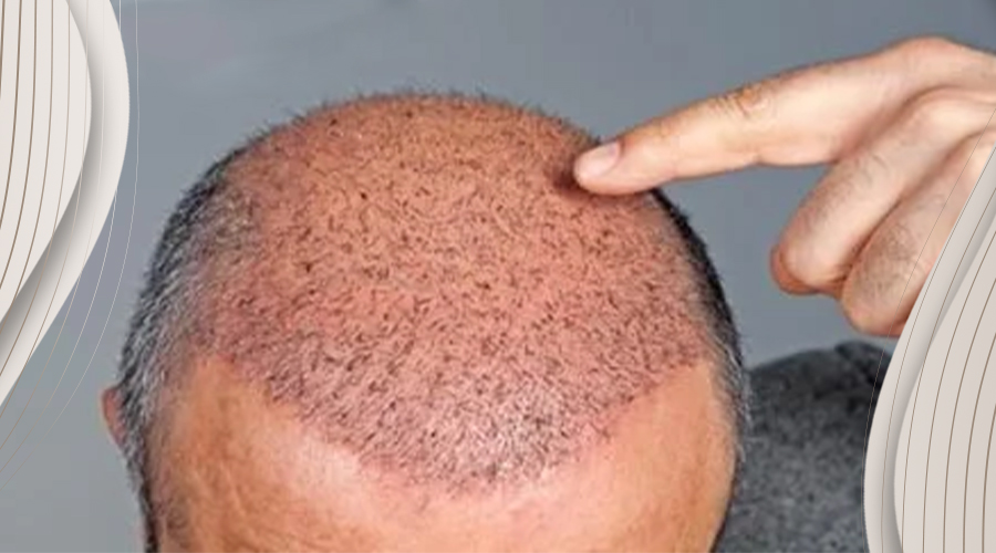 Hair Transplant Redness | Causes & How to Reduce It Safely