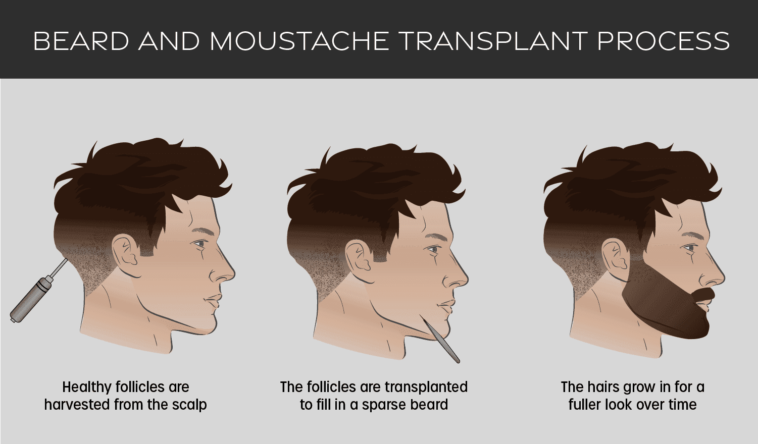 Cómo se realiza el trasplante de barba
