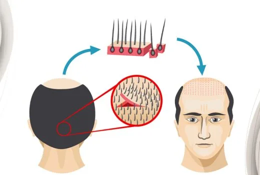 How Is Hair Transplant Performed In Turkey