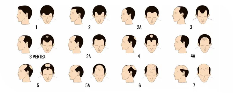 Understanding the Norwood Hair Scale: A Comprehensive Guide