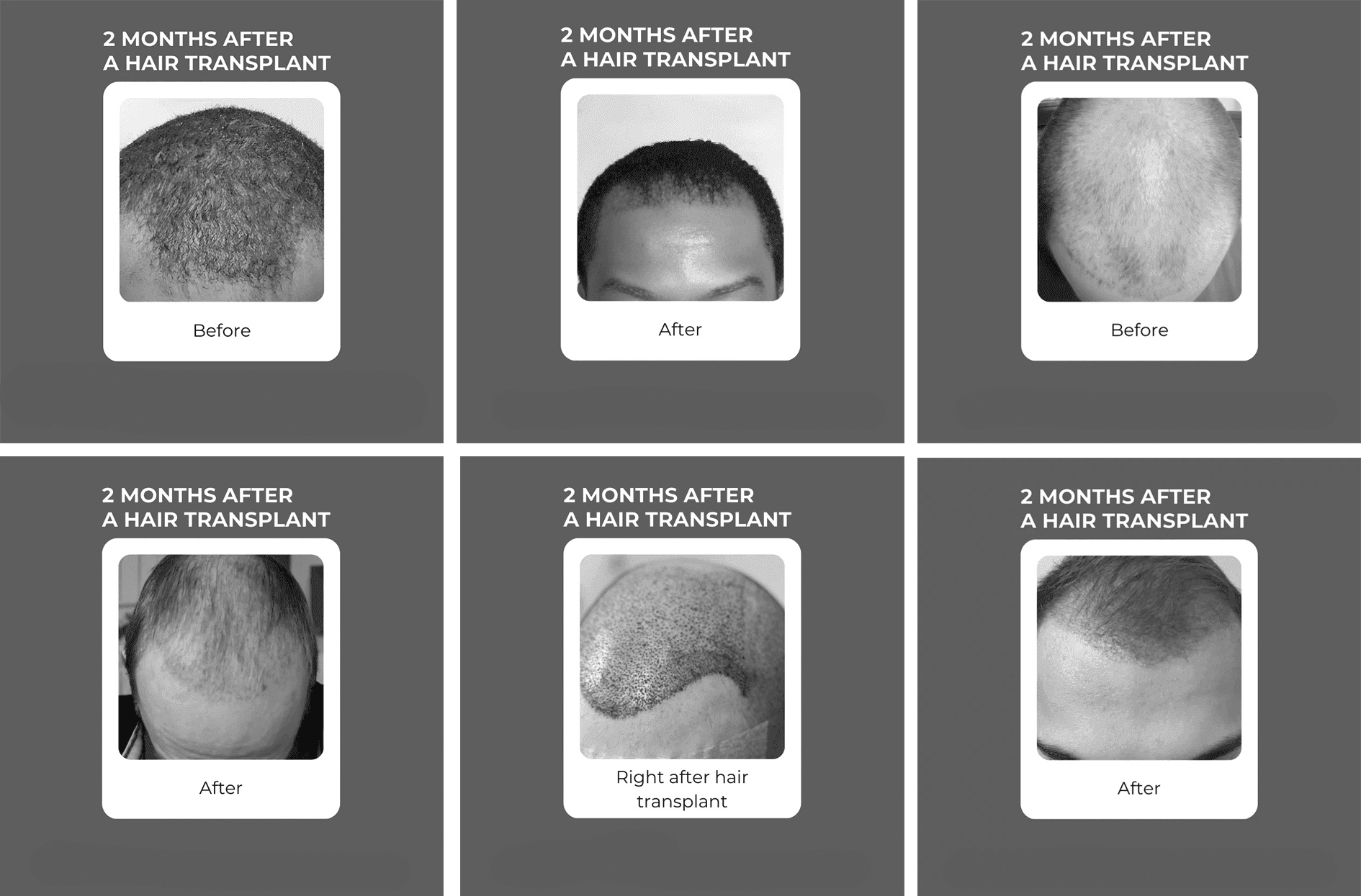 Post Care After Hair Transplant: Essential Tips for Fast Healing