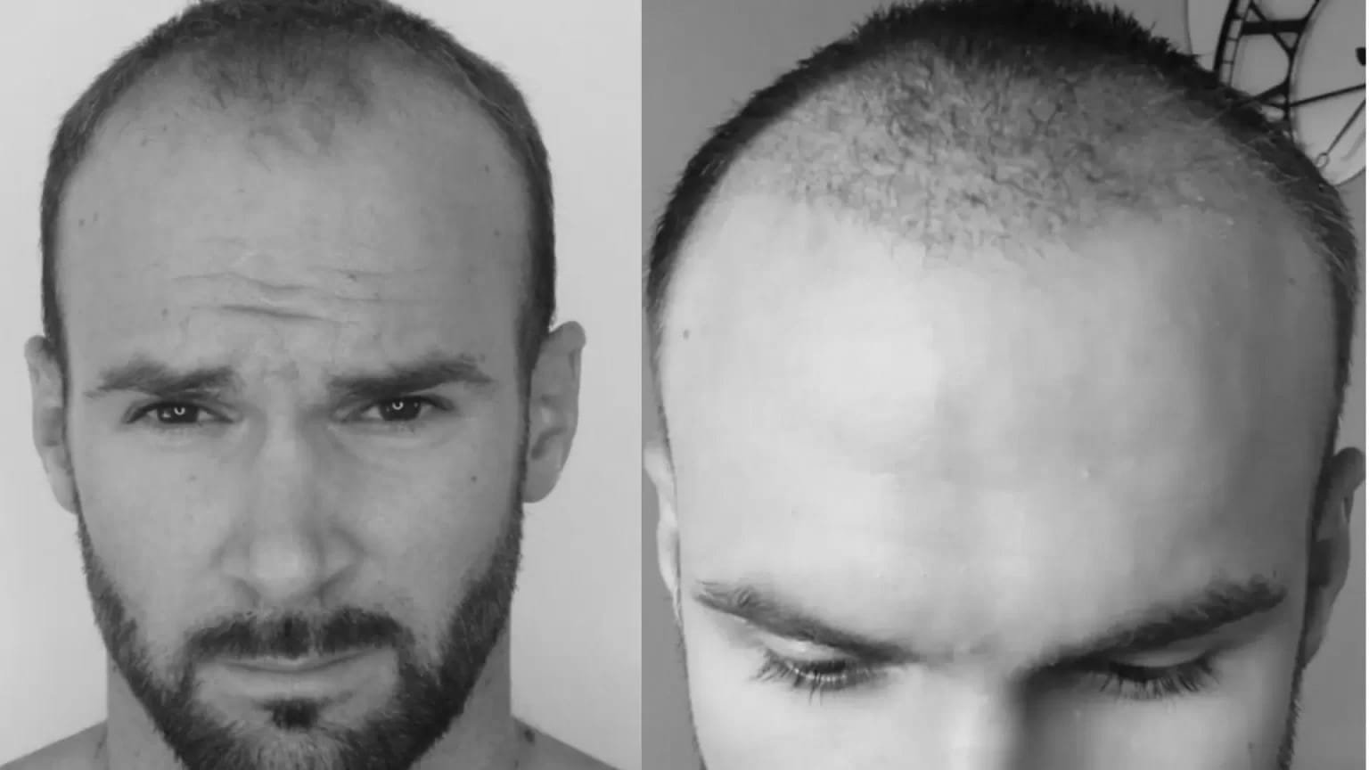 Foto prima e dopo di un uomo che mostra la perdita di capelli all'attaccatura anteriore prima del trapianto e la crescita precoce due mesi dopo l'intervento di trapianto di capelli.