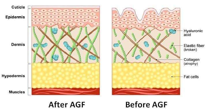 AGF-39 Haarausfall Behandlung in der Türkei