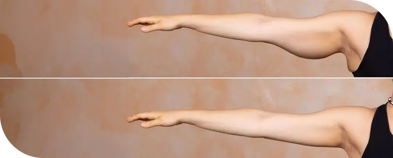 Arm Lift in Turkey - Brachioplasty