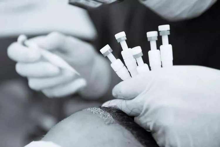 DHI hair transplant procedure using implanter pens