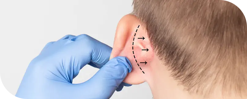 Otoplasty | Ear Surgery In Turkey