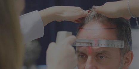 Definizione delle linee dei capelli con l'approccio laser