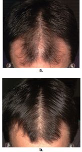 Facts About Androgenic Hair Loss In Men