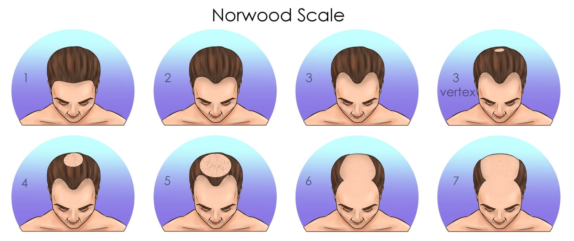 LA SCALA PER IL TRAPIANTO DI CAPELLI DI NORWOOD