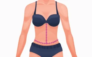 Addominoplastica Fleur De Lis - Tummy Tuck