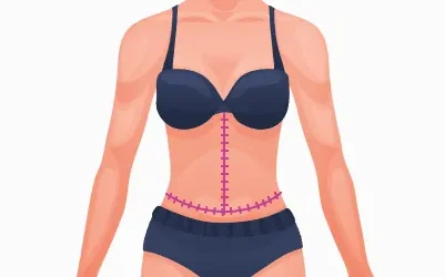 Fleur De Lis Abdominoplasty - Tummy Tuck