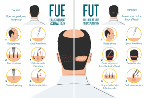 fue vs fut Haartransplantation