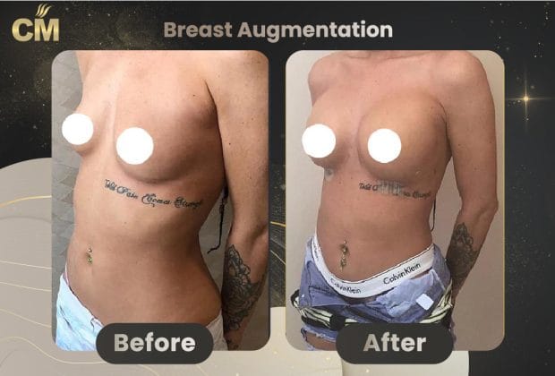 2Breast-Augmentation-08-620x420-1.jpg