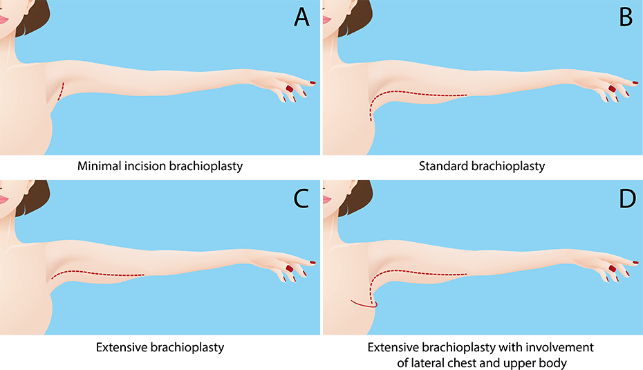 איך בוחרים בין מתיחה מינימלית, מתיחה רגילה, מתיחה מורחבת או שאיבת שומן בלבד?