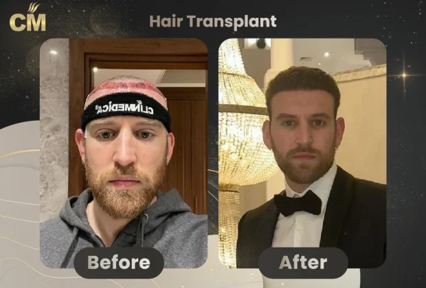 dhi-choi-pens-hair-transplant-before-after-in-turkey-49-620x420-1.webp