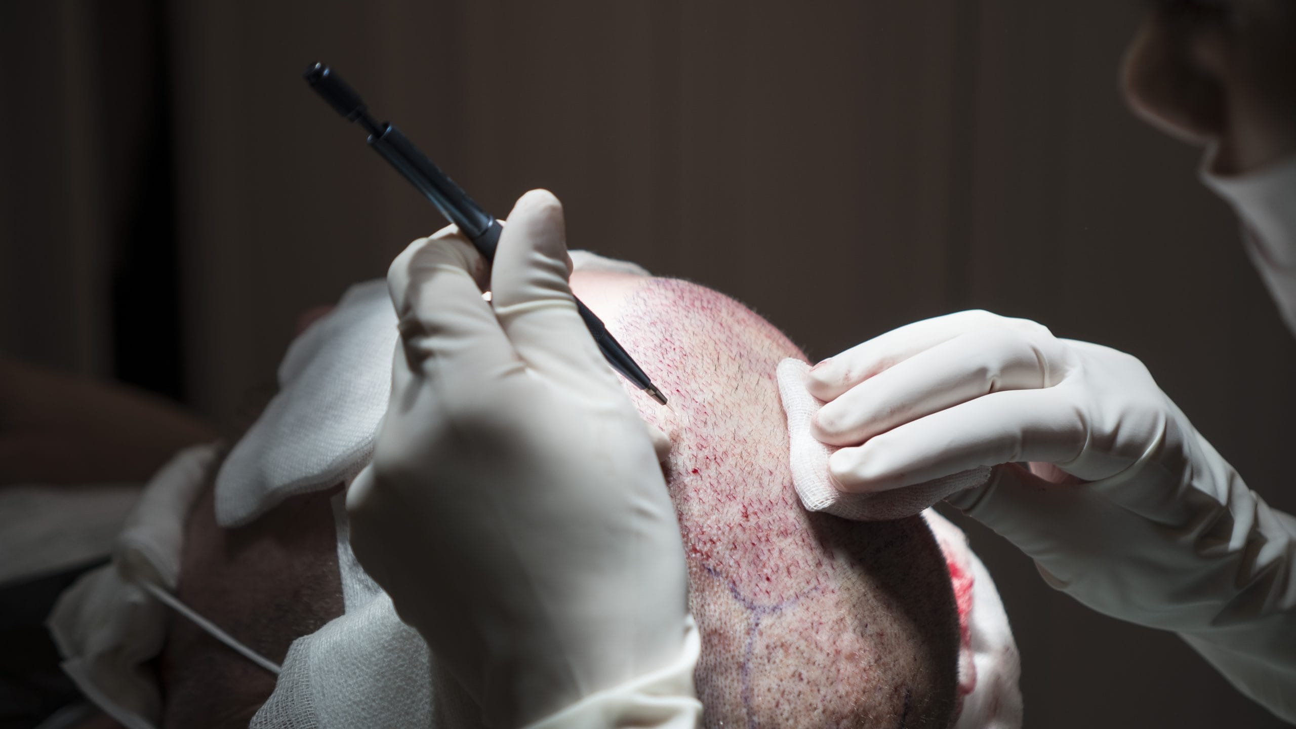 Fattori importanti da considerare quando si aprono i canali per l'impianto di capelli