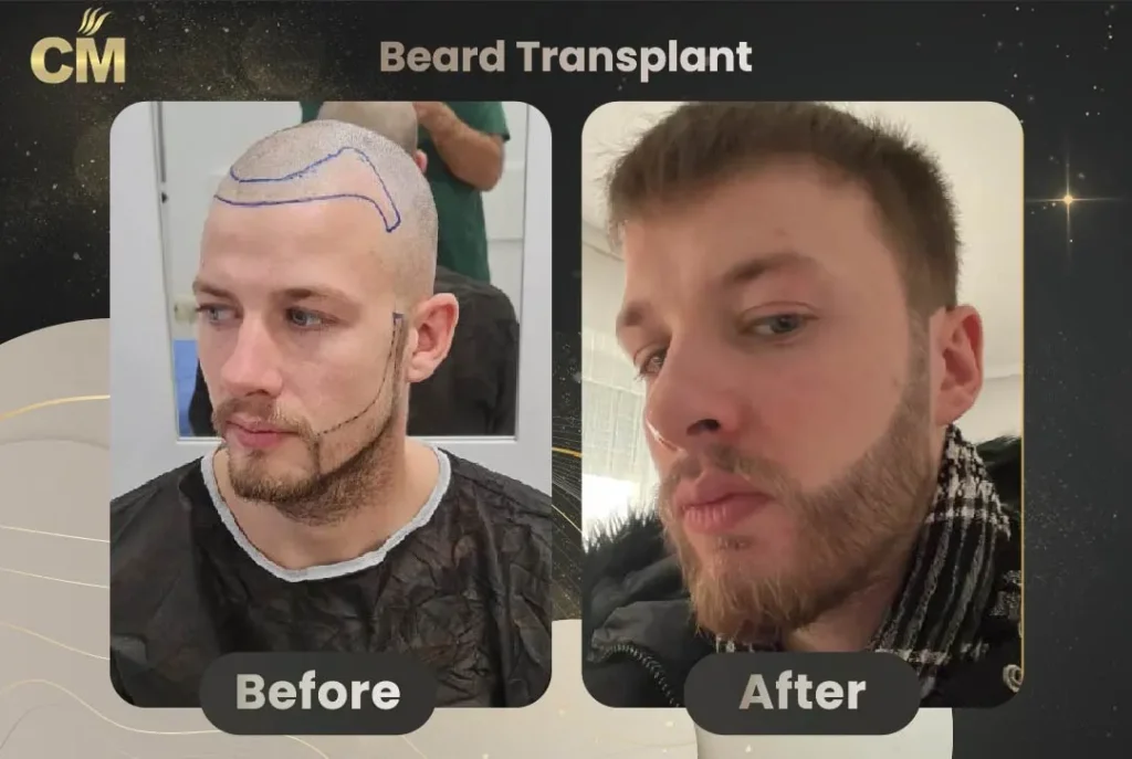 Before and after results of beard transplant in Turkey showing natural facial hair restoration