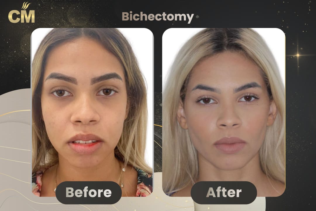 Bichectomy-04.jpg