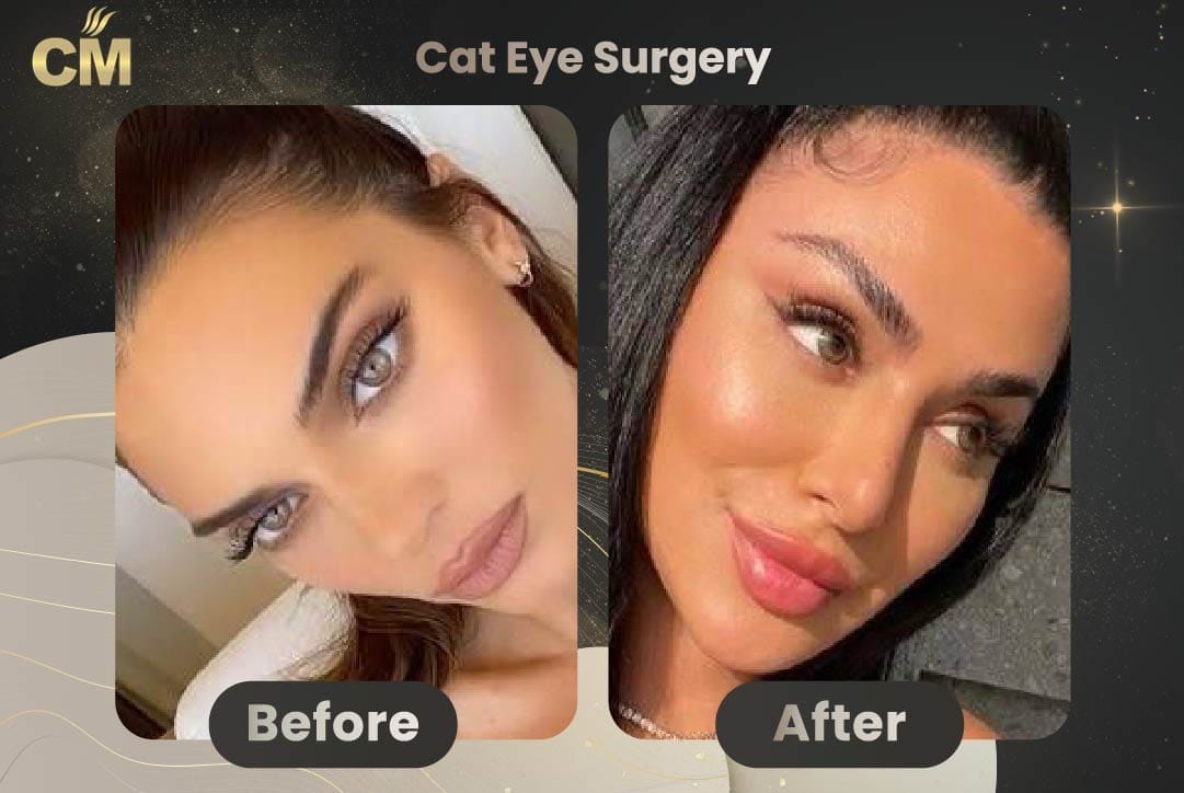 cat-eye-surgery-03.jpg