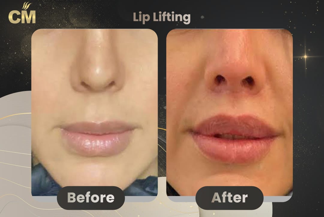 lip-lifting-11.jpg