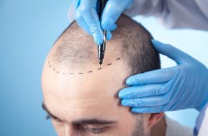 360 Hair Transplant in Turkey