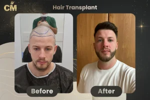 Trapianto di capelli dhi, prima e dopo in Turchia