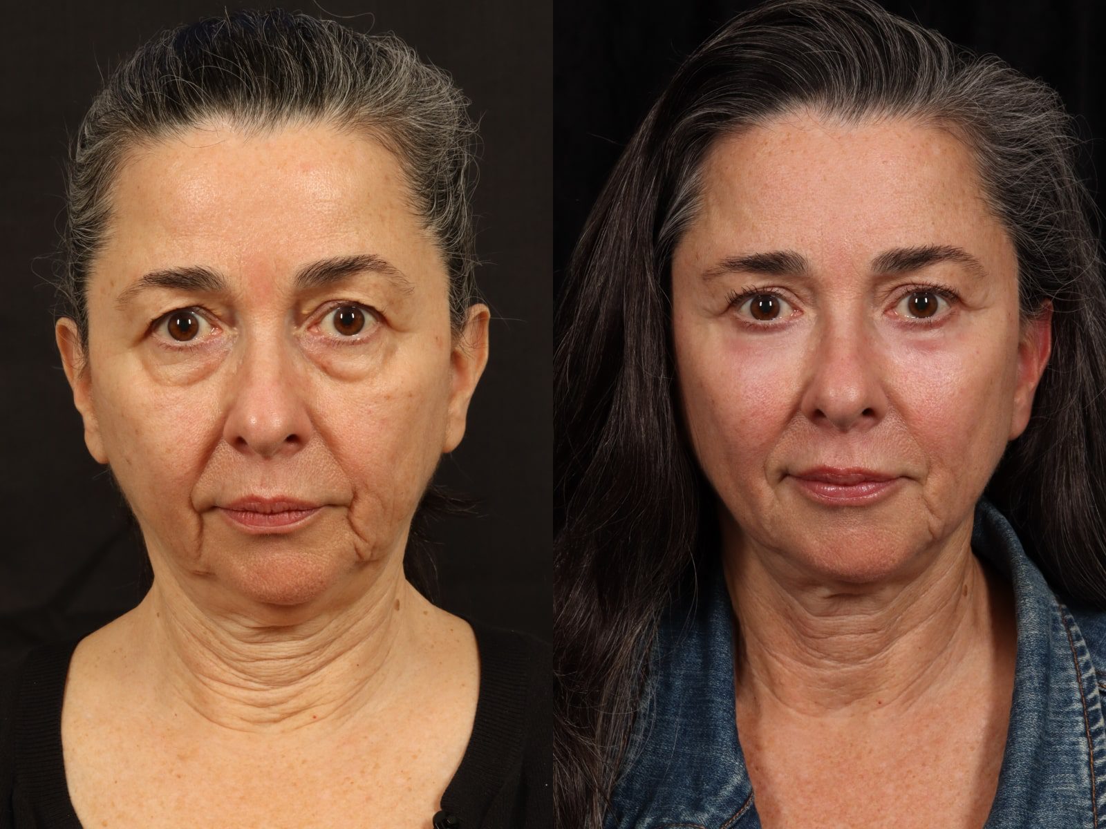 Mid Facelift Before After