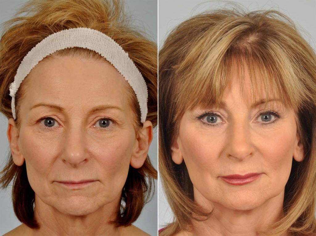 Mid Facelift Before After