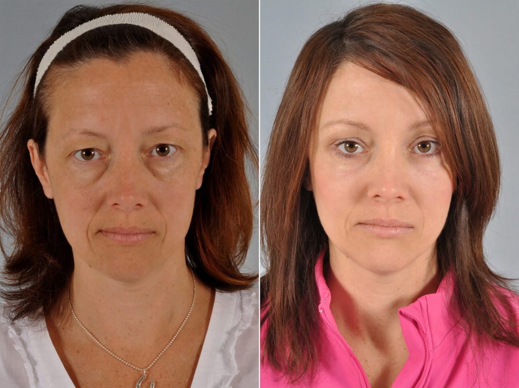 Mid Facelift Before After