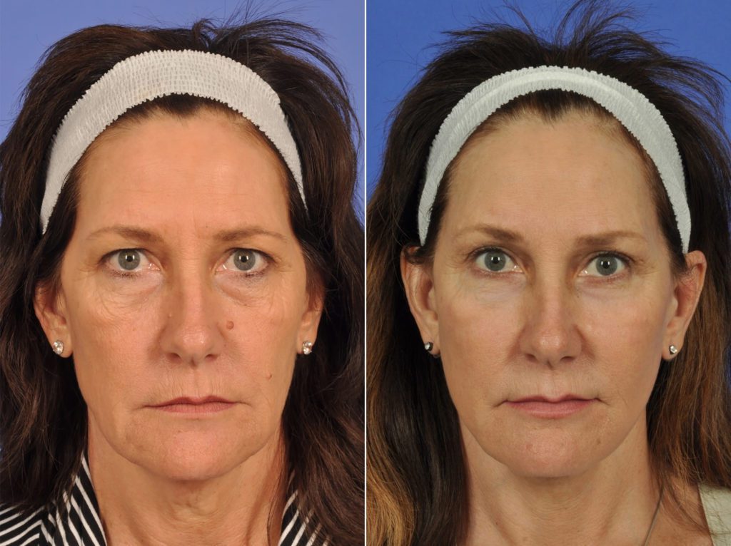 Mid Facelift Before After