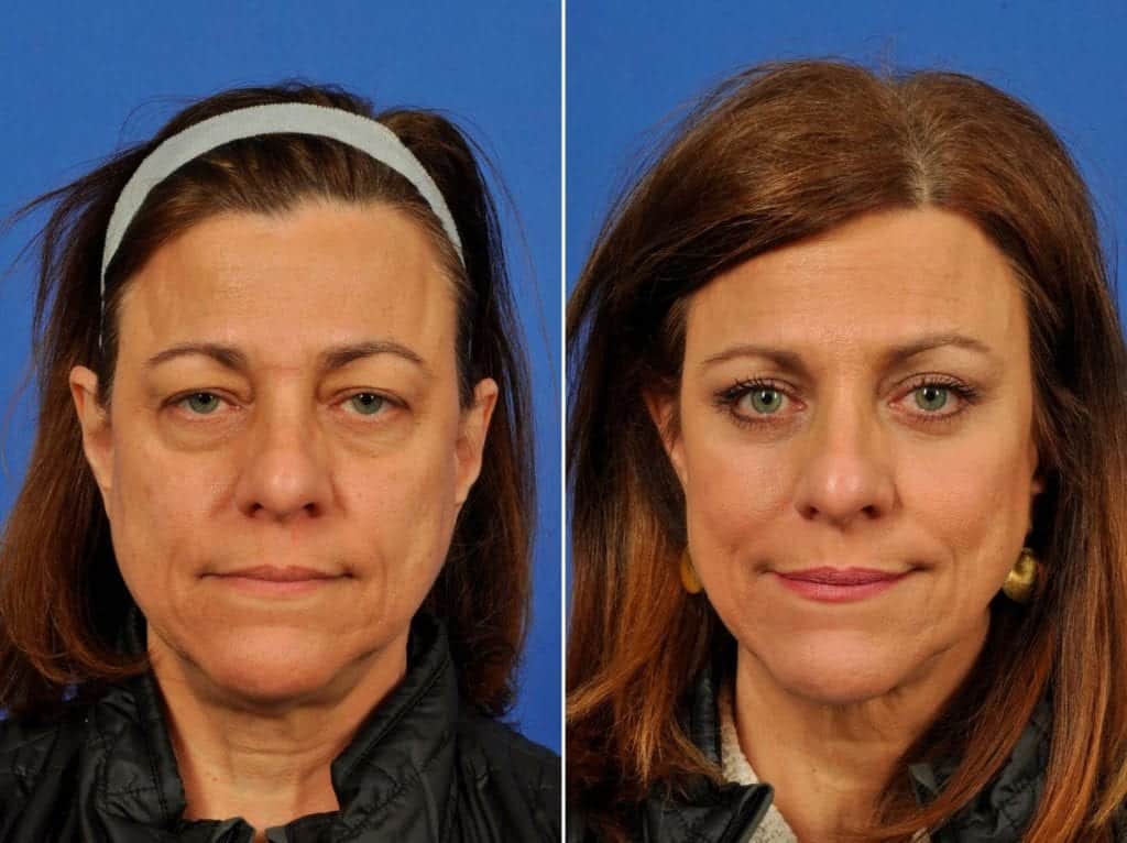 Mid Facelift Before After